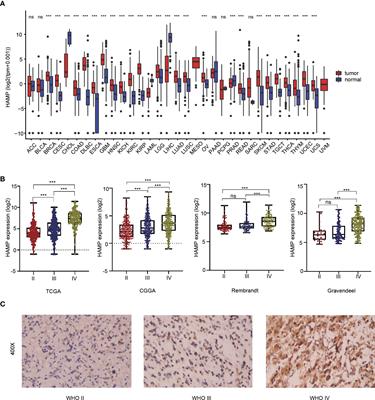 Hepcidin is upregulated and is a potential therapeutic target associated with immunity in glioma